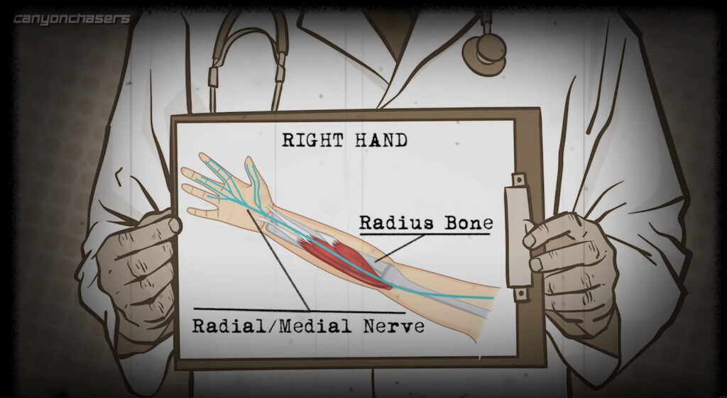 Radius Bone, Radial Nerve, Motorcycle Braking